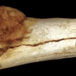 Fosil Purba Berusia 1,7 Juta Tahun Ungkap Manusia Pertama Yang Kena Kanker